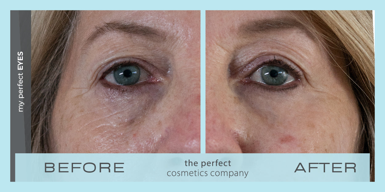 Before and after under eye puffiness, eye bags, fine lines and wrinkles, My Perfect Eyes results, lower eye blepharoplasty alternative