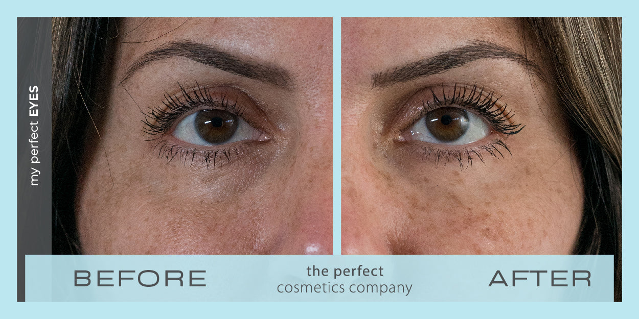 My Perfect Eyes before and after results for under eye puffiness, eye bags, fine lines and wrinkles, lower eye blepharoplasty alternative