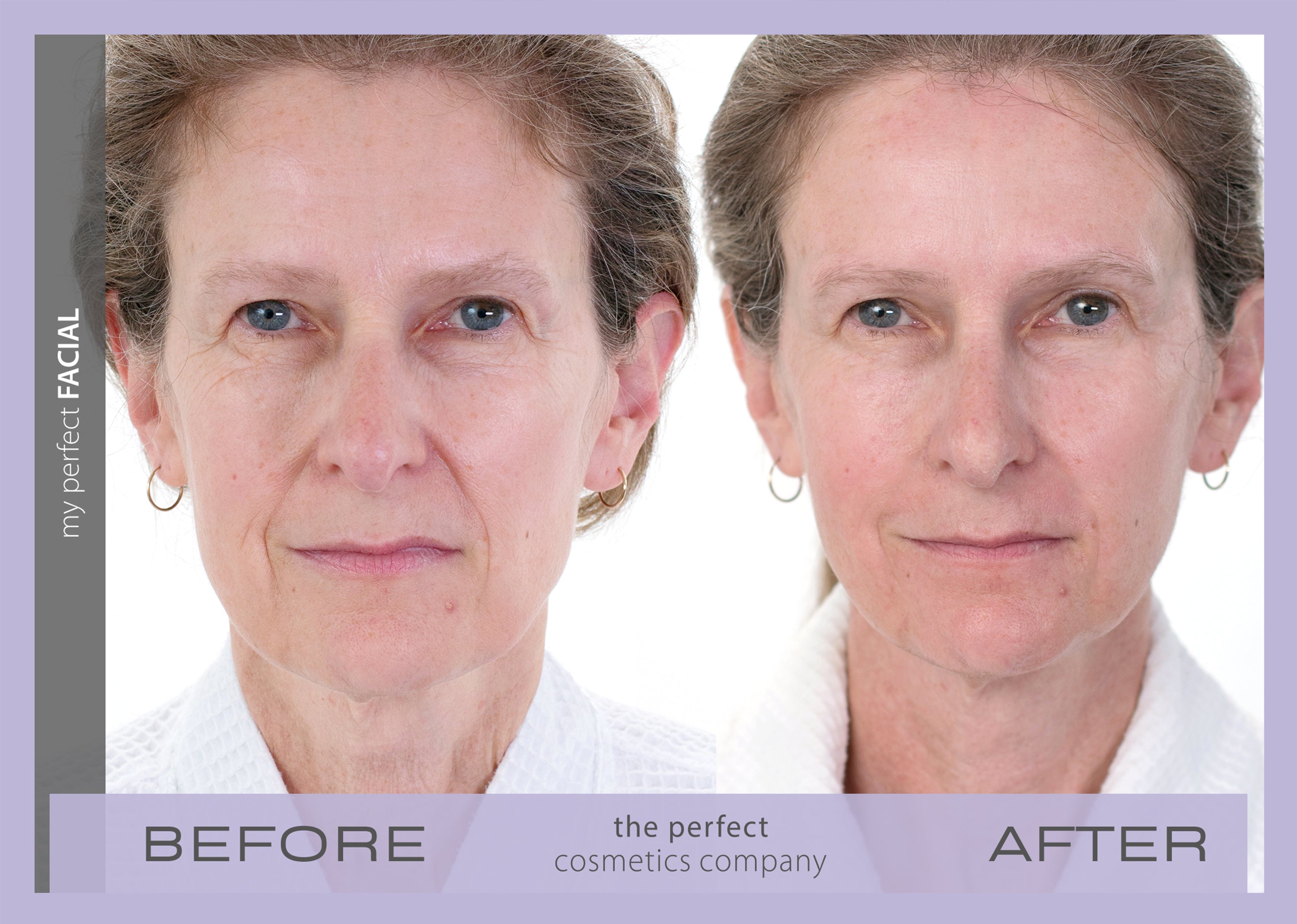 My Perfect Facial before and after results showing visible skin tightening and reduced wrinkles, delivering non-surgical facial rejuvenation for a youthful appearance.