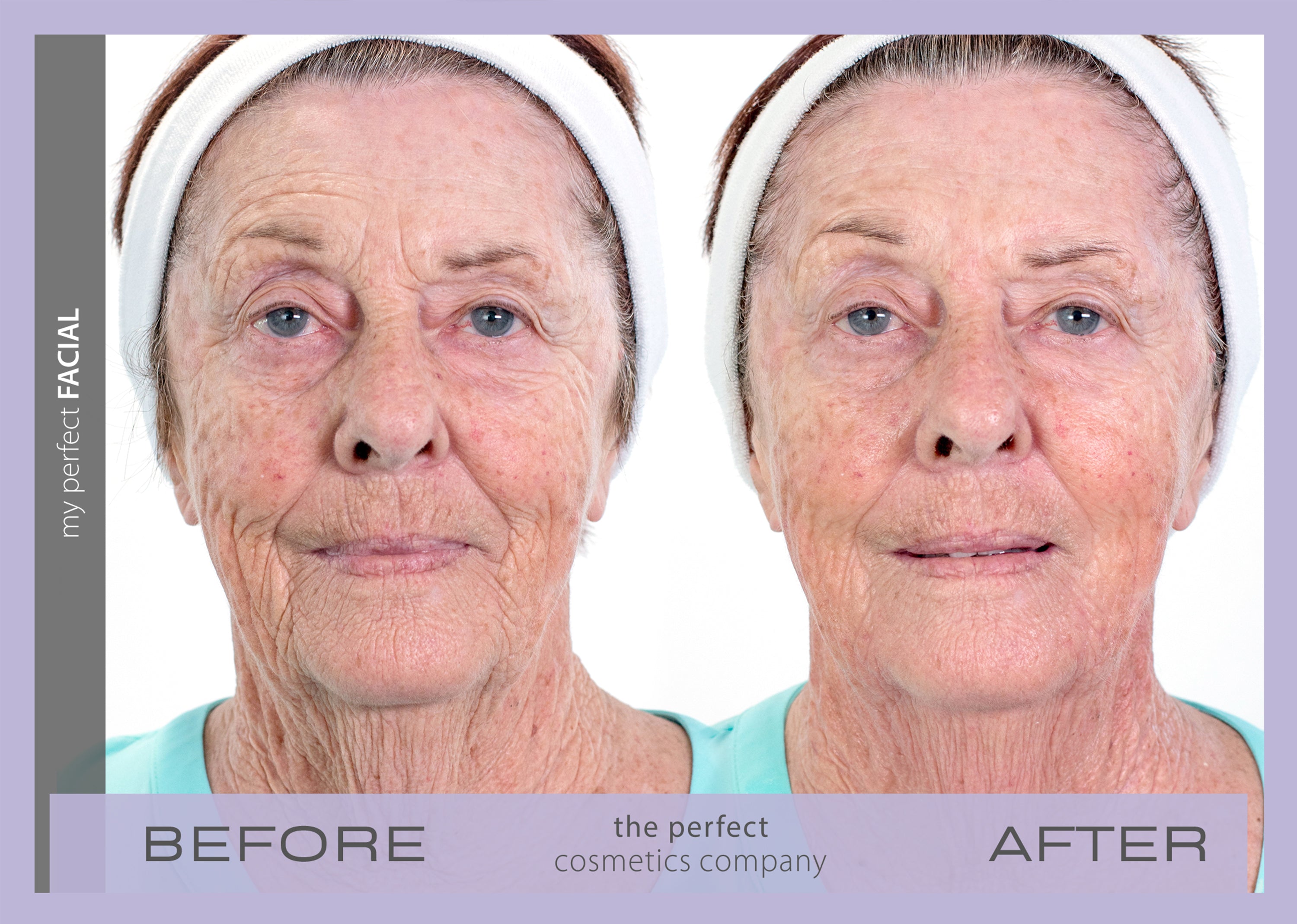 My Perfect Facial before and after results showing visible skin tightening and reduced wrinkles, delivering non-surgical facial rejuvenation for a youthful appearance.