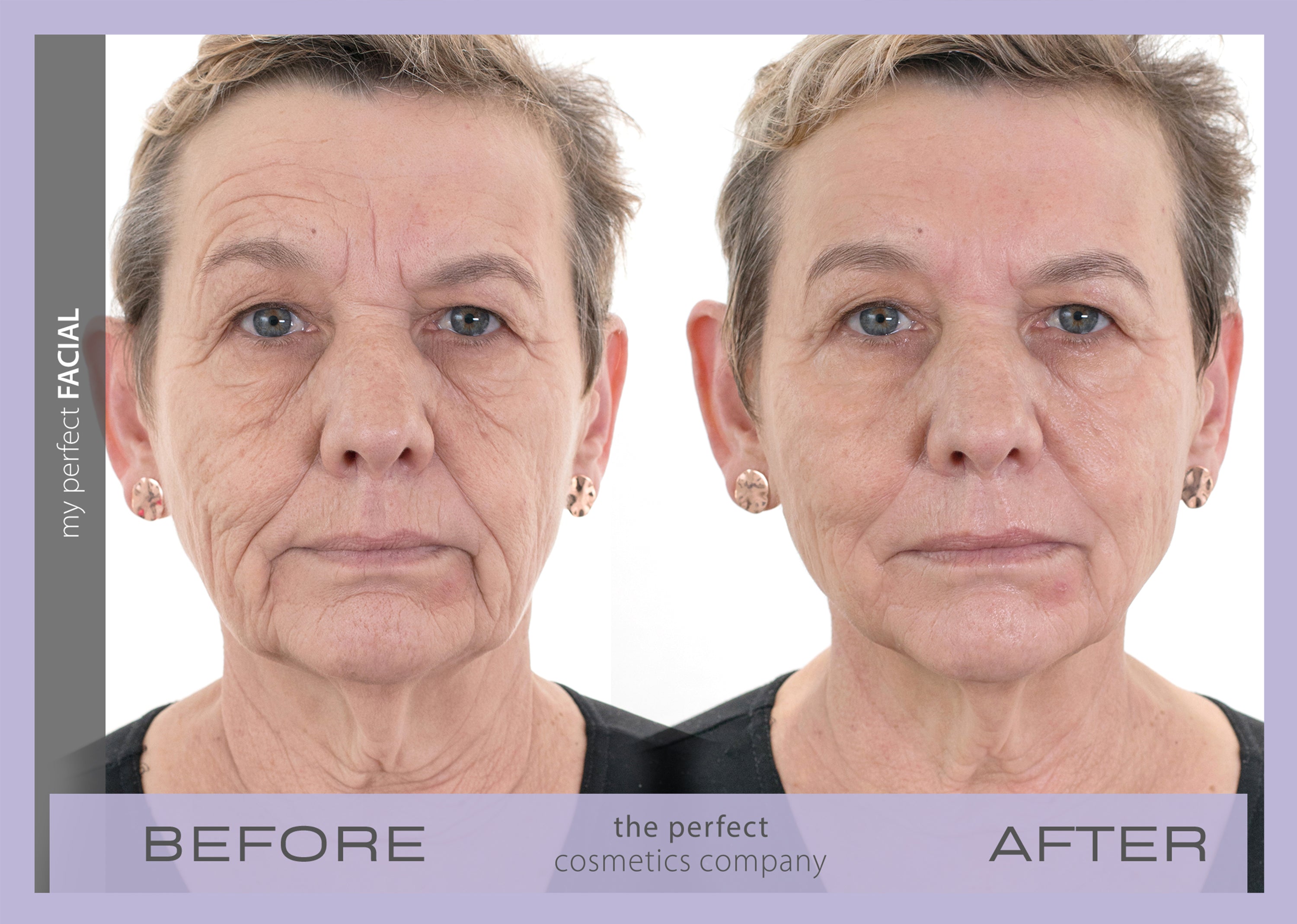 My Perfect Facial before and after results showing visible skin tightening and reduced wrinkles, delivering non-surgical facial rejuvenation for a youthful appearance.